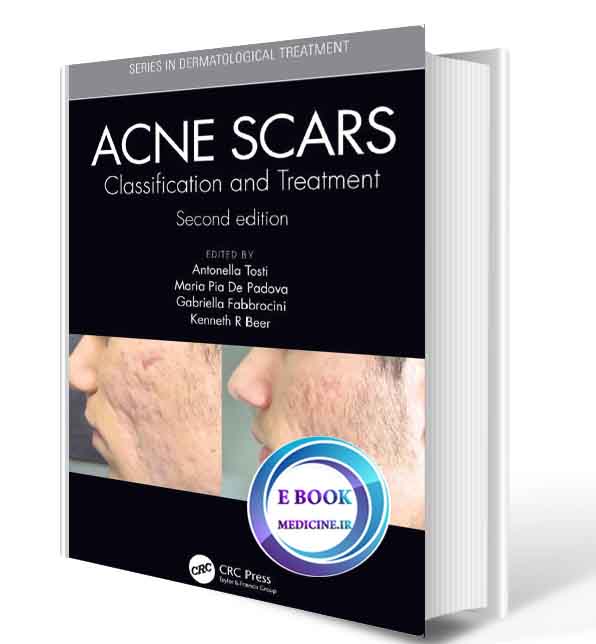 دانلود کتاب Acne Scars: Classification and Treatment2019 ( ORIGINAL PDF) 